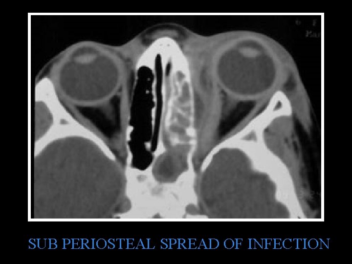 SUB PERIOSTEAL SPREAD OF INFECTION 