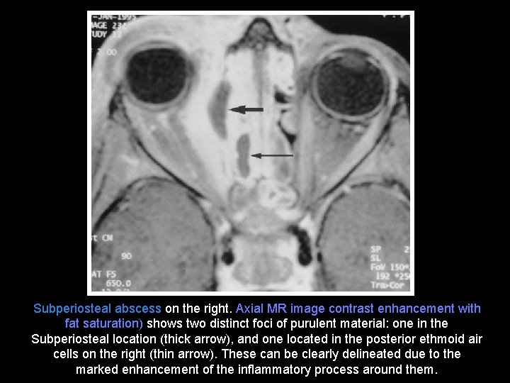 Subperiosteal abscess on the right. Axial MR image contrast enhancement with fat saturation) shows