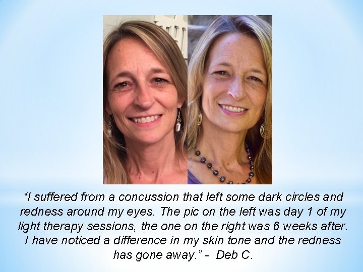 “I suffered from a concussion that left some dark circles and redness around my
