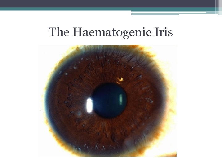 The Haematogenic Iris The Haematogenic Iris