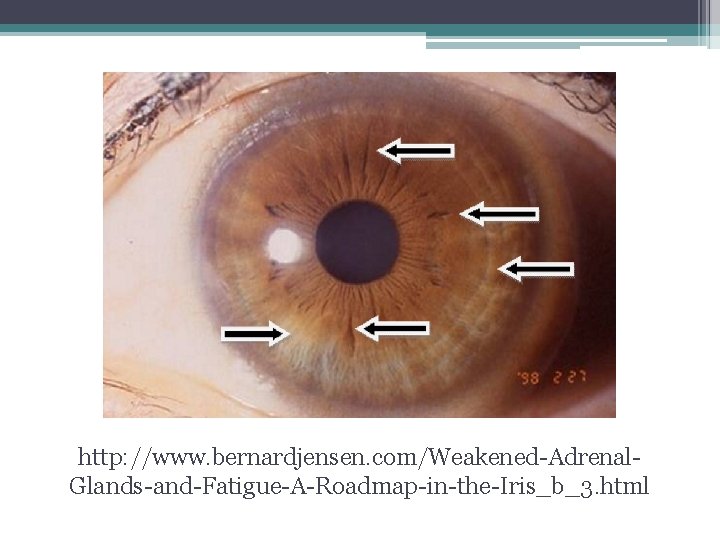 http: //www. bernardjensen. com/Weakened-Adrenal. Glands-and-Fatigue-A-Roadmap-in-the-Iris_b_3. html http: //www. bernardjensen. com/Weakened-Adrenal. Glands-and-Fatigue-A-Roadmap-in-the-Iris_b_3. html