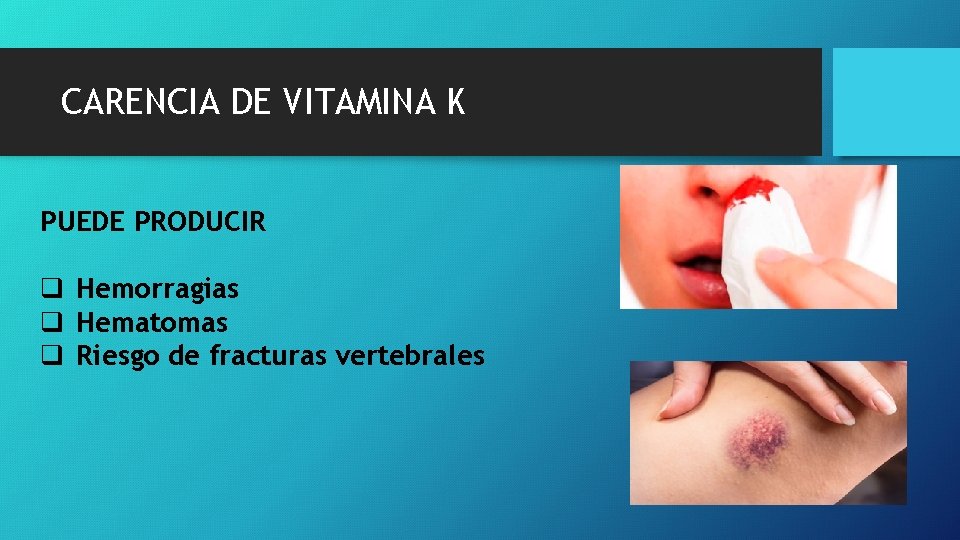 CARENCIA DE VITAMINA K PUEDE PRODUCIR q Hemorragias q Hematomas q Riesgo de fracturas CARENCIA DE VITAMINA K PUEDE PRODUCIR q Hemorragias q Hematomas q Riesgo de fracturas