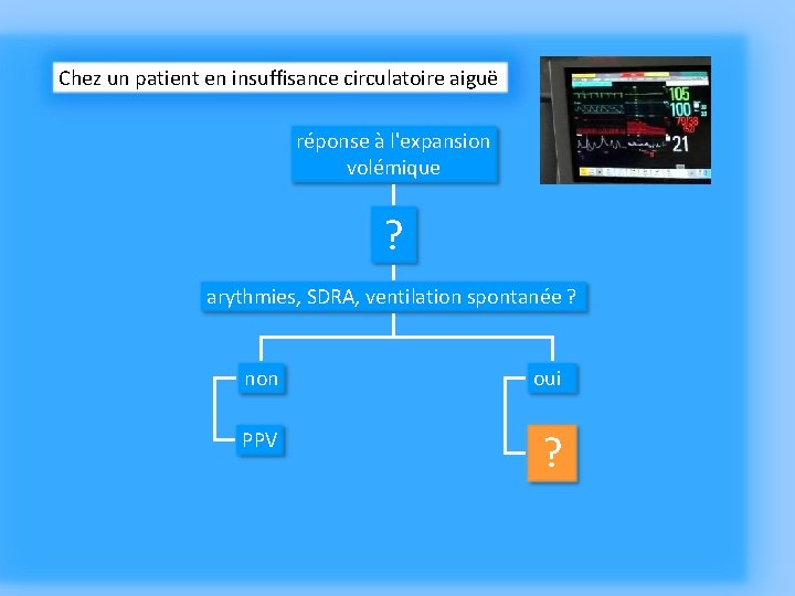 Chez un patient en insuffisance circulatoire aiguë réponse à l'expansion volémique ? arythmies, SDRA,