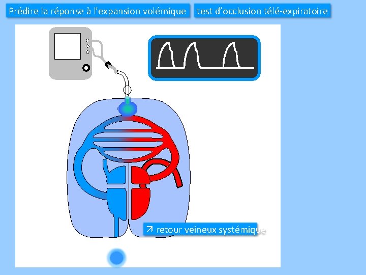 Prédire la réponse à l’expansion volémique test d’occlusion télé-expiratoire ä retour veineux systémique 