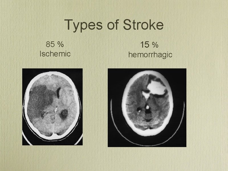 Types of Stroke 85 % Ischemic 15 % hemorrhagic 