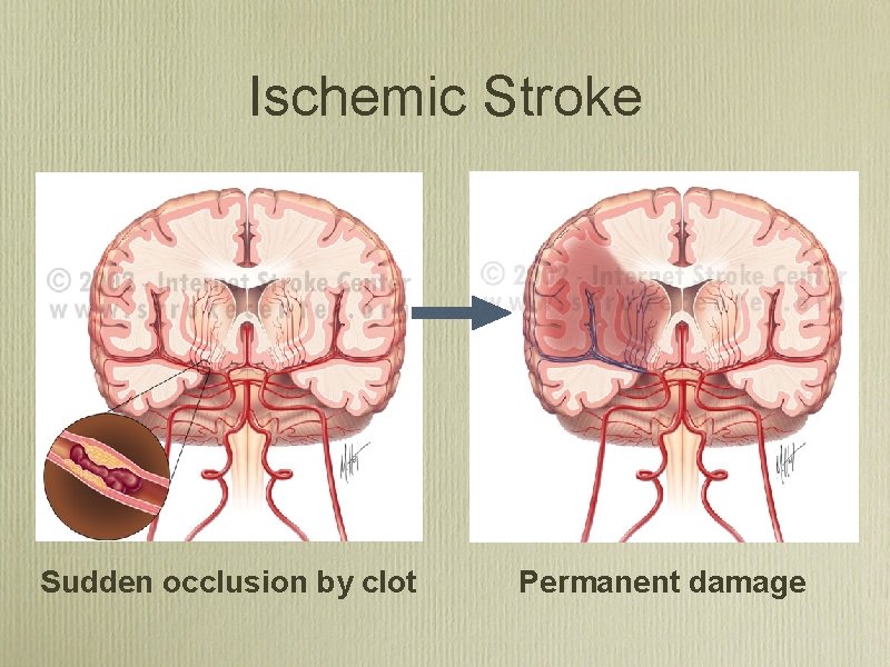 Ischemic Stroke Sudden occlusion by clot Permanent damage 