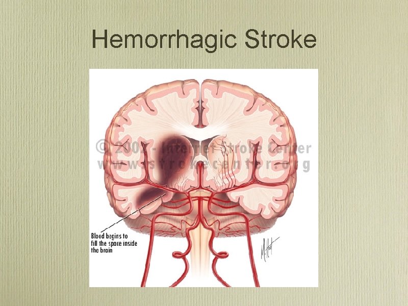 Hemorrhagic Stroke 
