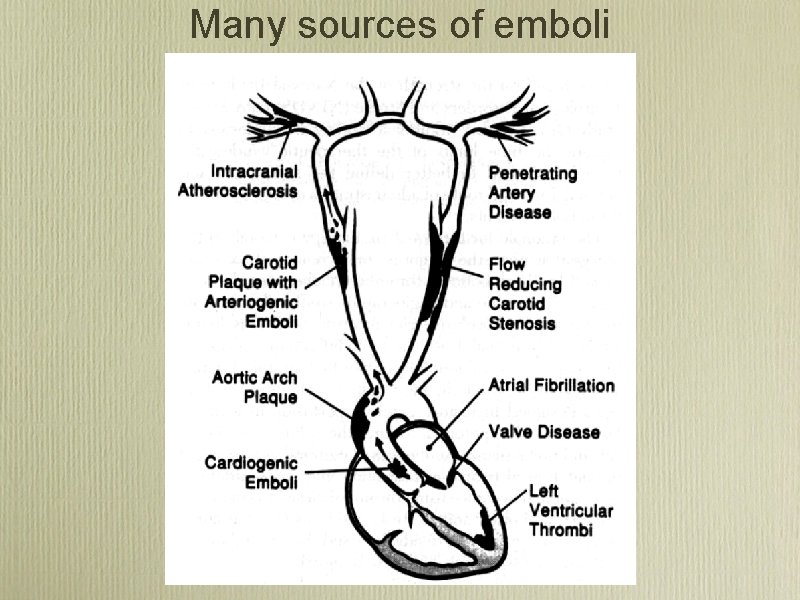 Many sources of emboli 