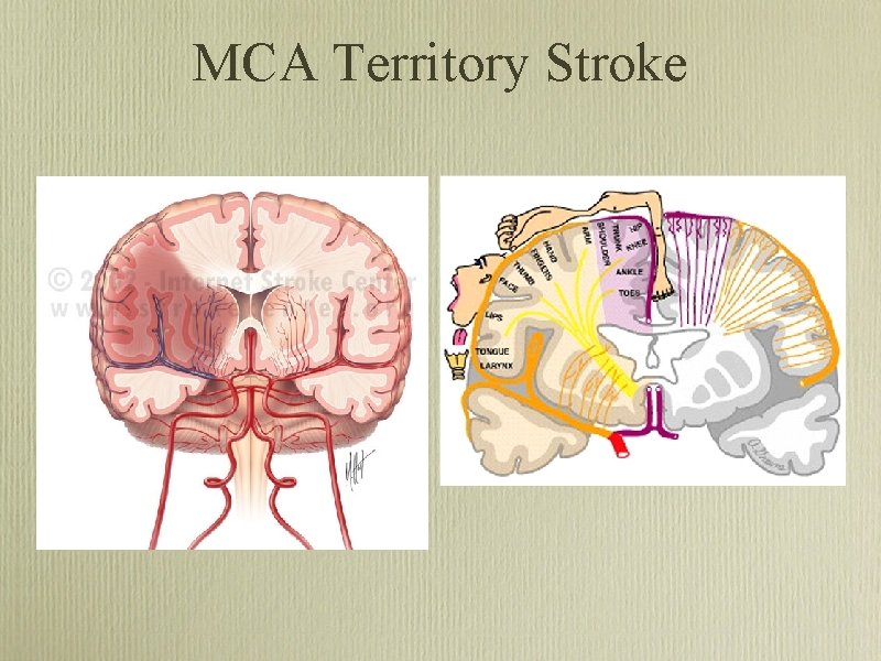 MCA Territory Stroke 