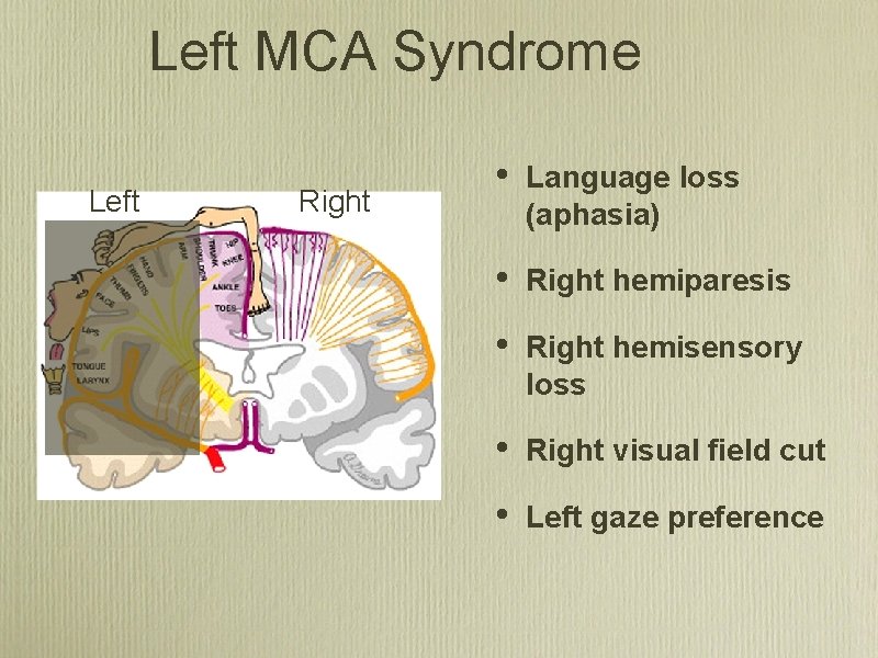 Left MCA Syndrome Left Right • Language loss (aphasia) • Right hemiparesis • Right