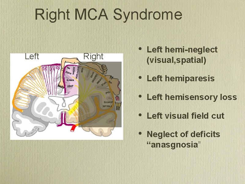 Right MCA Syndrome Left Right • Left hemi-neglect (visual, spatial) • Left hemiparesis •