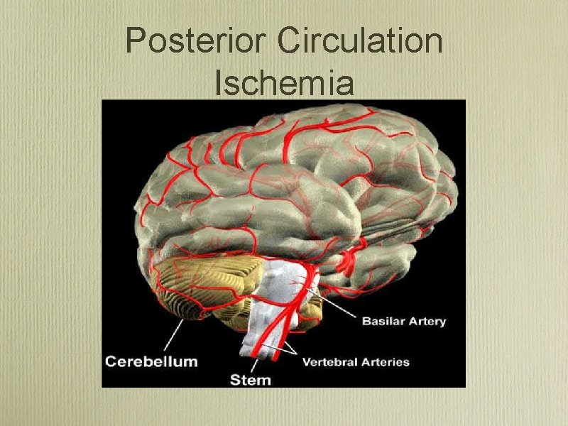 Posterior Circulation Ischemia 