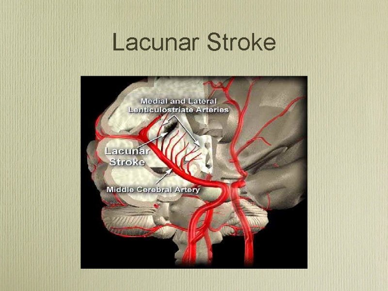 Lacunar Stroke 