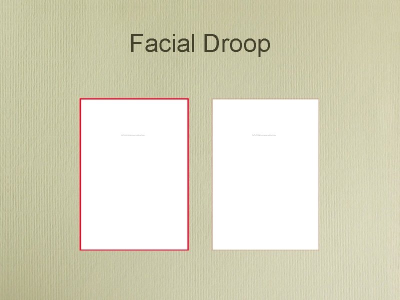 Facial Droop 