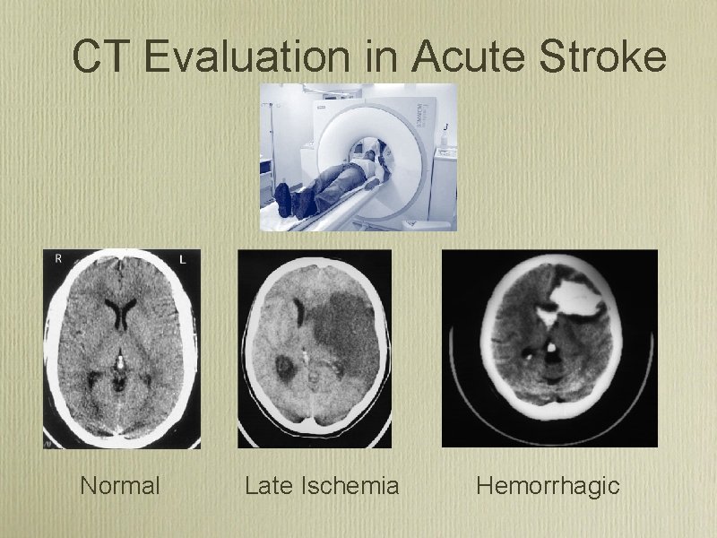 CT Evaluation in Acute Stroke Normal Late Ischemia Hemorrhagic 