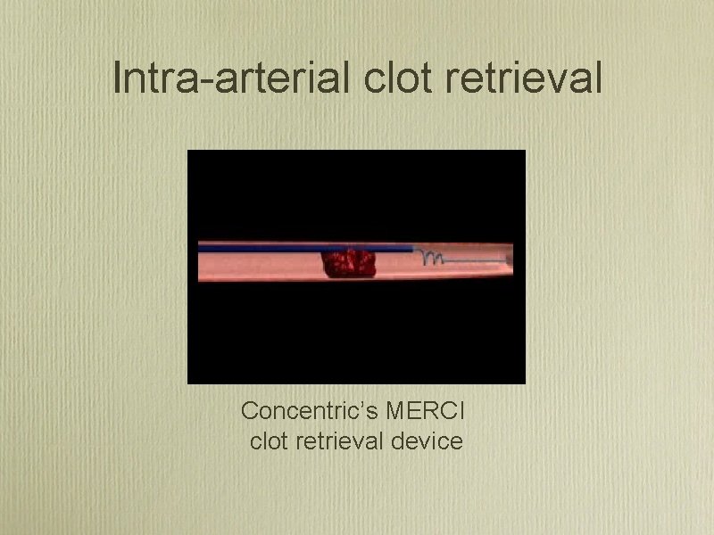 Intra arterial clot retrieval Concentric’s MERCI clot retrieval device 