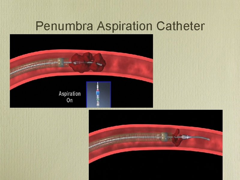 Penumbra Aspiration Catheter 