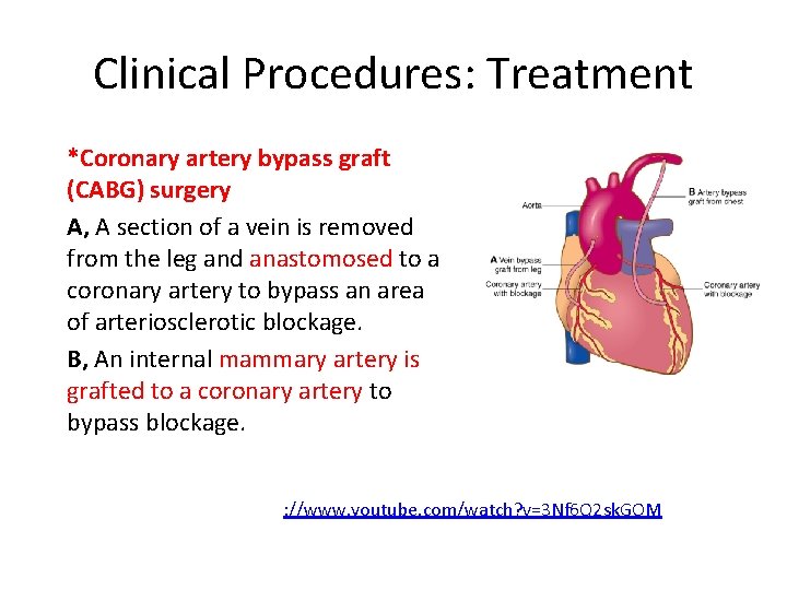 Clinical Procedures: Treatment *Coronary artery bypass graft (CABG) surgery A, A section of a