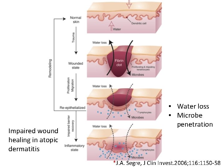 Impaired wound healing in atopic dermatitis • Water loss • Microbe penetration *J. A.