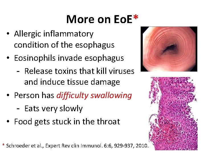 More on Eo. E* • Allergic inflammatory condition of the esophagus • Eosinophils invade