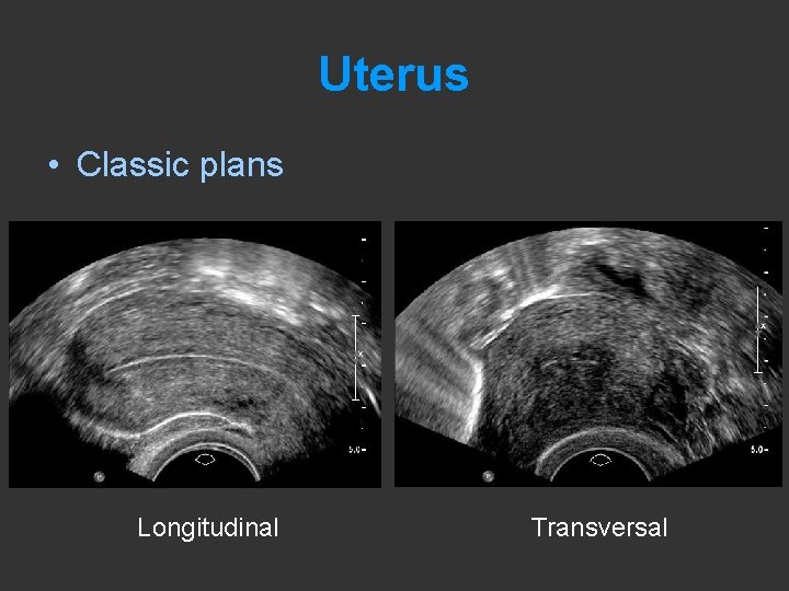 Uterus • Classic plans Longitudinal Transversal 