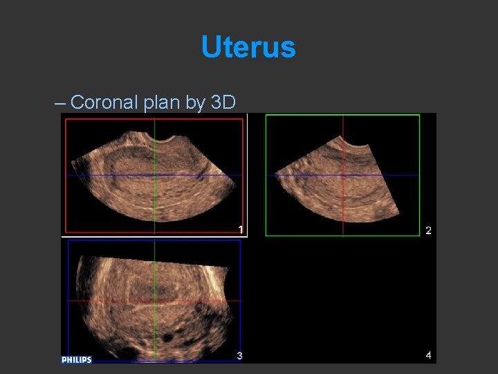 Uterus – Coronal plan by 3 D 