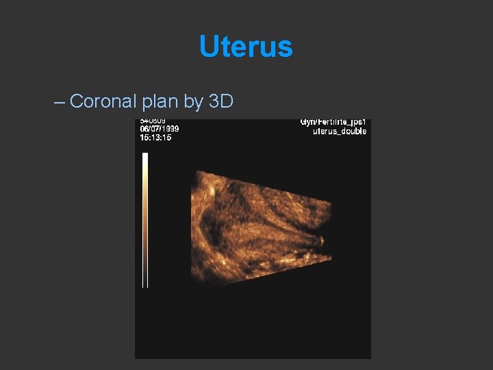 Uterus – Coronal plan by 3 D 