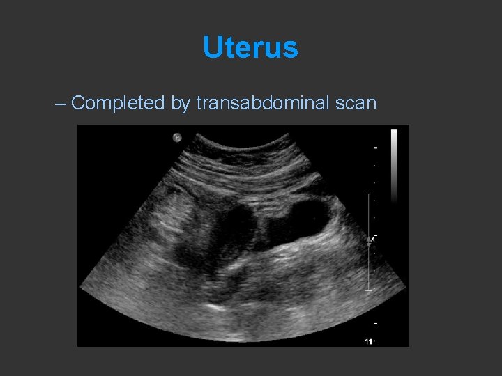 Uterus – Completed by transabdominal scan 