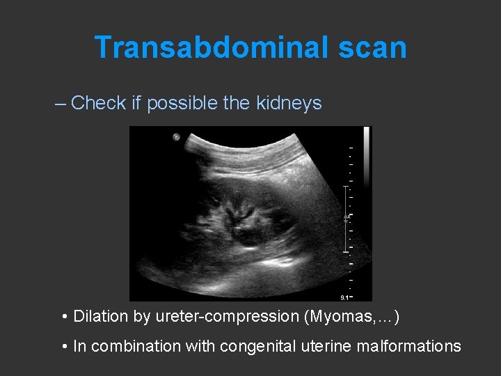 Transabdominal scan – Check if possible the kidneys • Dilation by ureter-compression (Myomas, …)