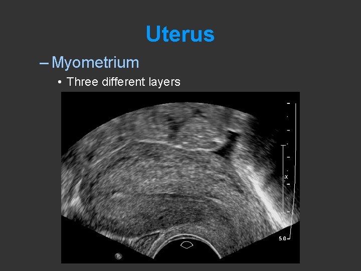 Uterus – Myometrium • Three different layers 