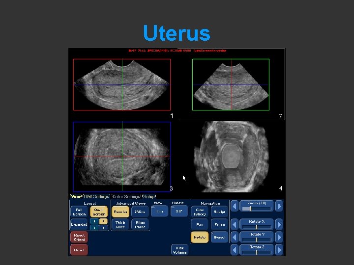 Uterus 