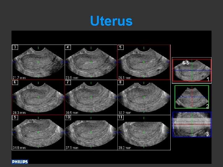 Uterus 