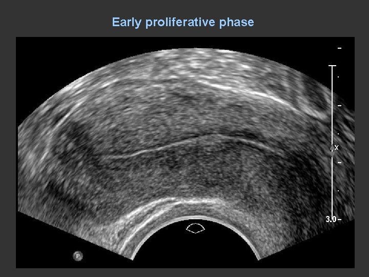 Early proliferative phase 