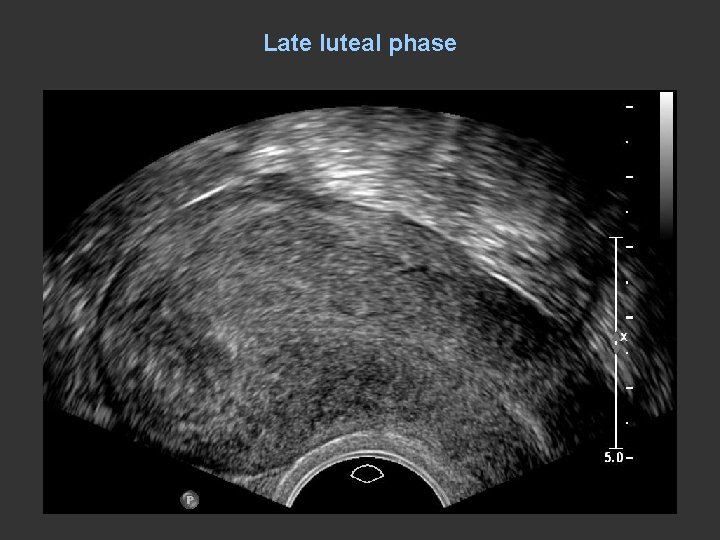 Late luteal phase 
