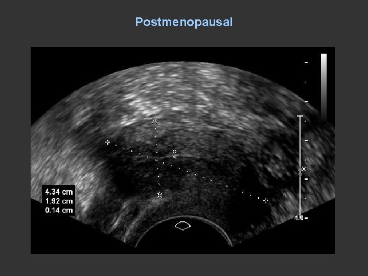 Postmenopausal 