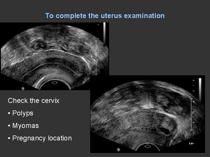 To complete the uterus examination Check the cervix • Polyps • Myomas • Pregnancy