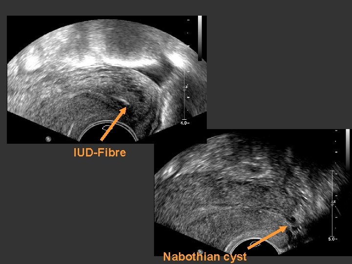 IUD-Fibre Nabothian cyst 