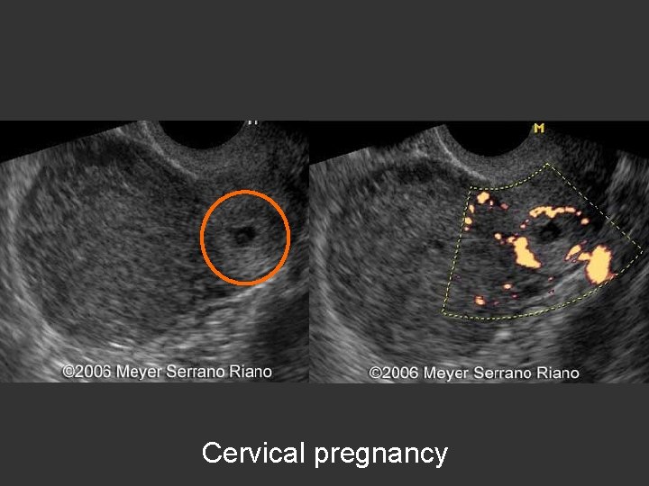 Cervical pregnancy 