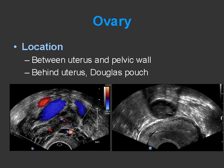 Ovary • Location – Between uterus and pelvic wall – Behind uterus, Douglas pouch