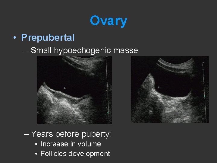 Ovary • Prepubertal – Small hypoechogenic masse – Years before puberty: • Increase in