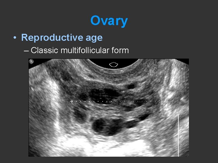 Ovary • Reproductive age – Classic multifollicular form 