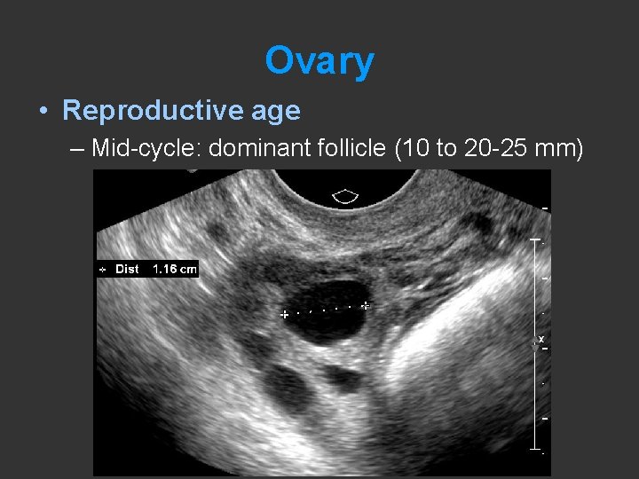 Ovary • Reproductive age – Mid-cycle: dominant follicle (10 to 20 -25 mm) 