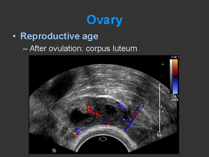 Ovary • Reproductive age – After ovulation: corpus luteum 