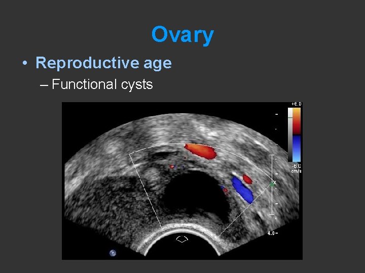 Ovary • Reproductive age – Functional cysts 