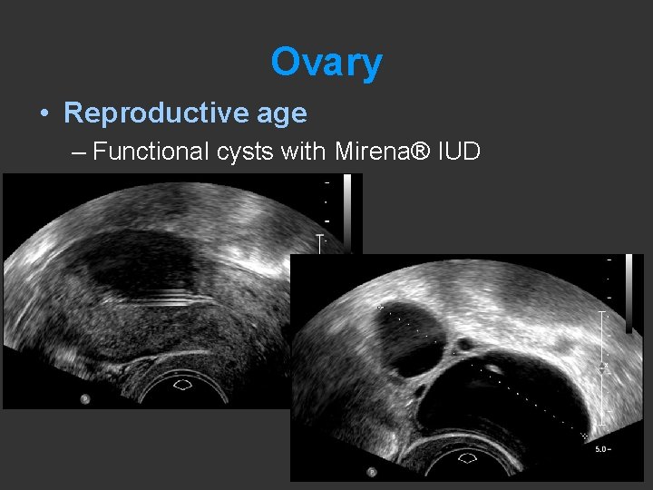 Ovary • Reproductive age – Functional cysts with Mirena® IUD 