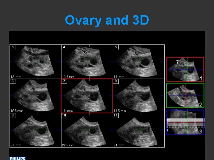 Ovary and 3 D 