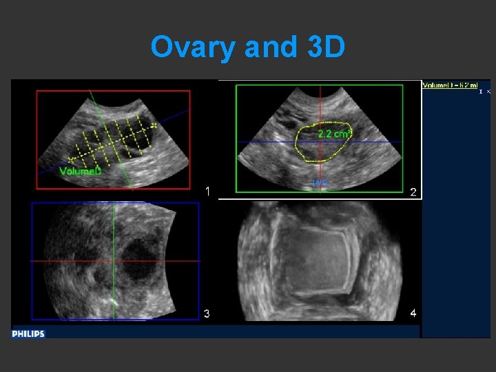 Ovary and 3 D 