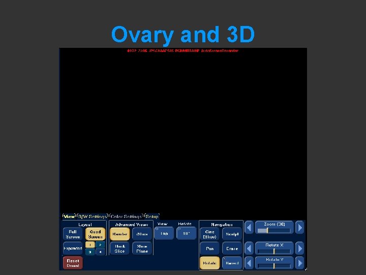 Ovary and 3 D 