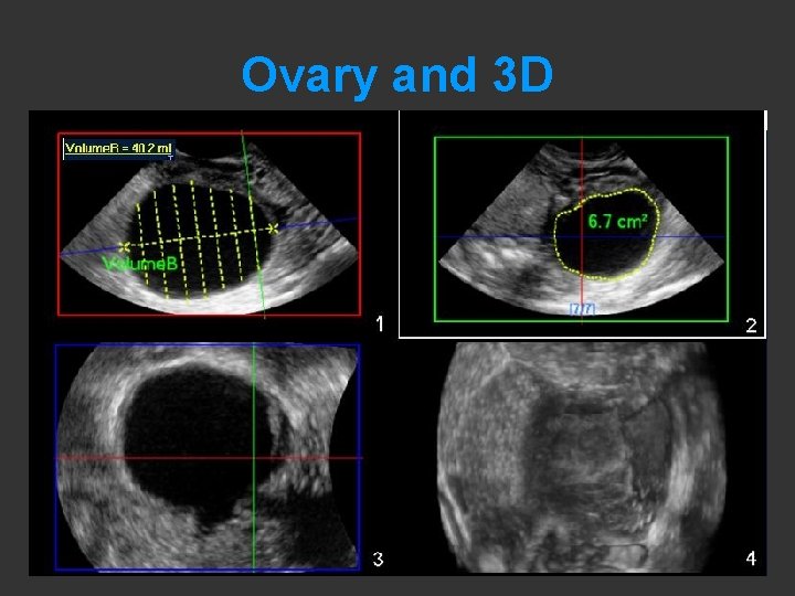 Ovary and 3 D 