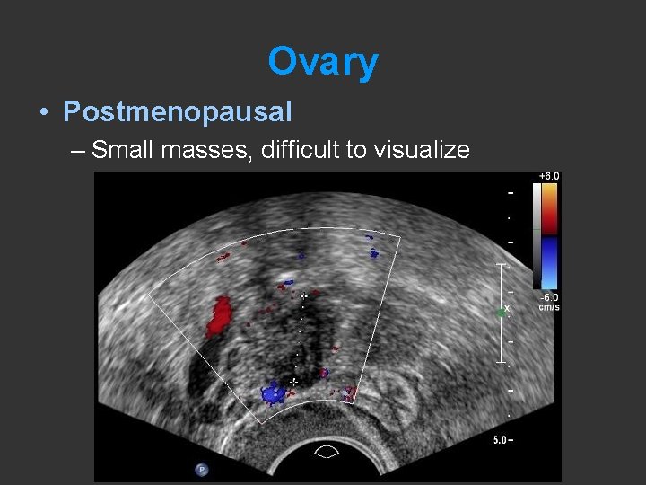 Ovary • Postmenopausal – Small masses, difficult to visualize 